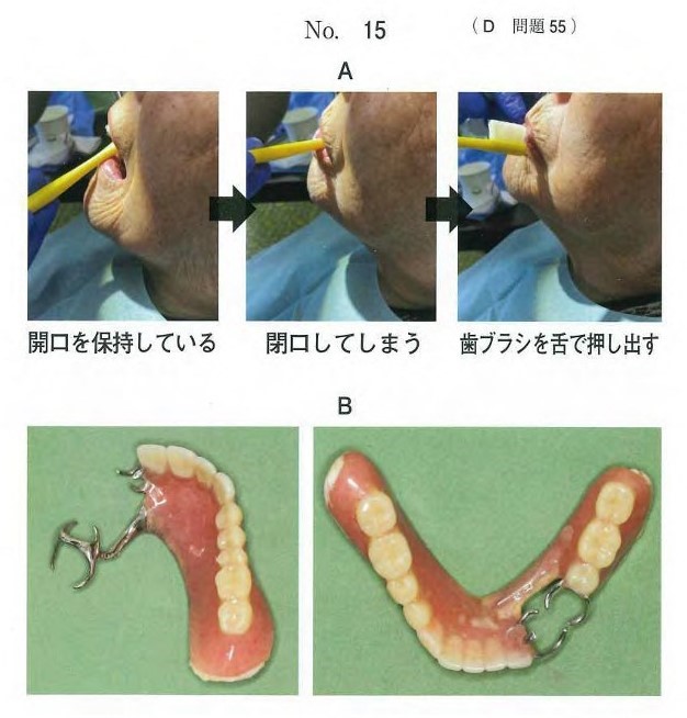 一連の動作の写真と使用中の義歯の写真