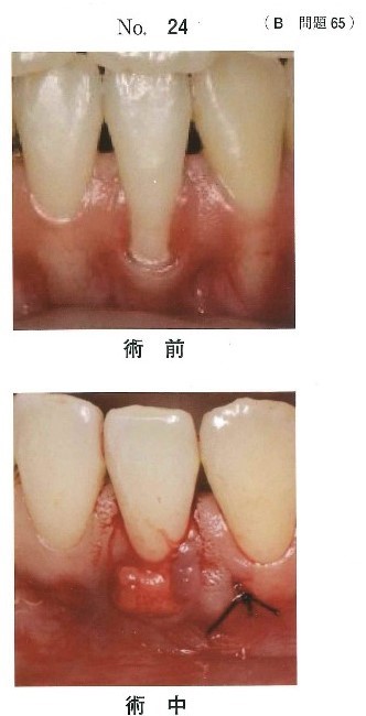 歯周形成手術の術前と術中の口腔内写真