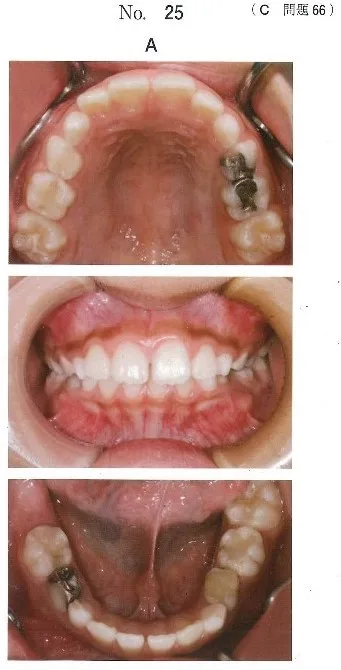 歯科医師国家試験 第116回 C66問題 | 歯科国試ドットコム