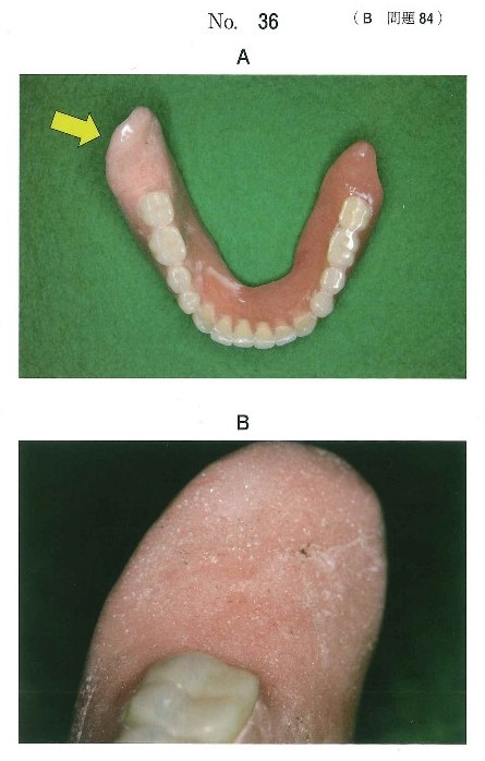 下顎全部床義歯の写真・矢印の部分を拡大した写真
