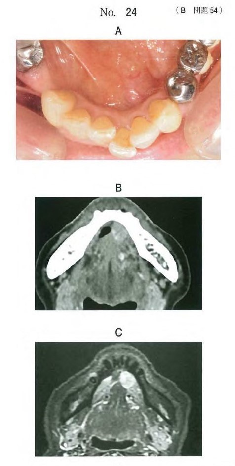 口腔内写真、造影CT、MRI脂肪抑制T2強調像
