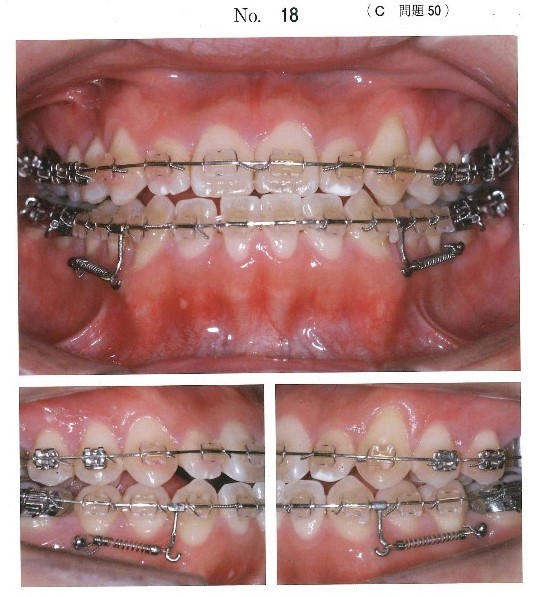 矯正歯科治療中の口腔内写真