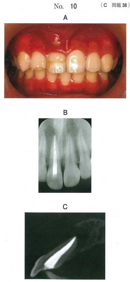 口腔内写真、エックス線画像及び根管充塡後の歯科用コーンビームCT