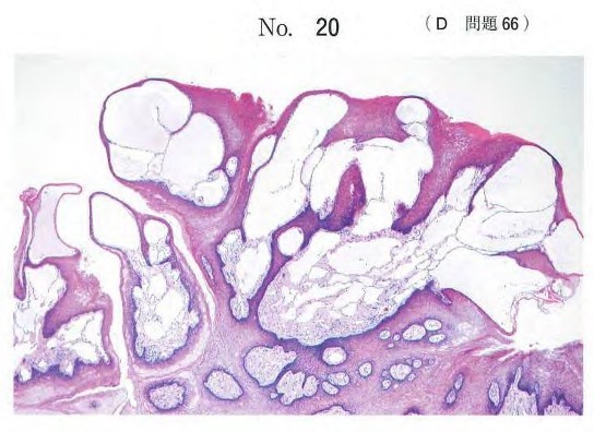 舌腫瘤の切除物のΗ-E染色病理組織像
