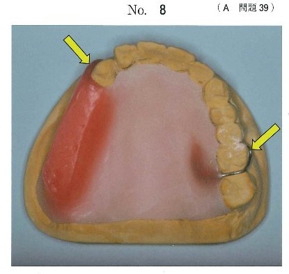 部分床義歯製作のための技工物の写真