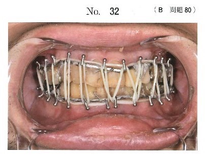 観血的整復固定術後の口腔内写真