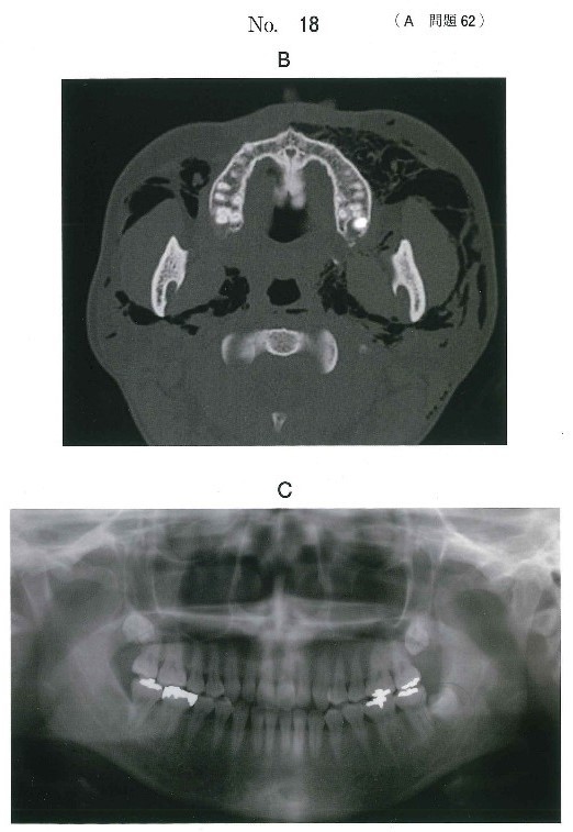 CT及び抜歯前のエックス線画像