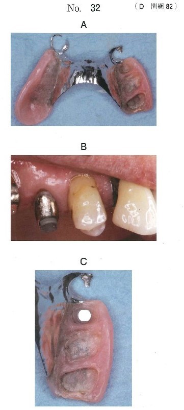 義歯床粘膜面の写真、支台歯上に装置を適合させた口腔内写真、及び修理後の義歯床粘膜面の写真