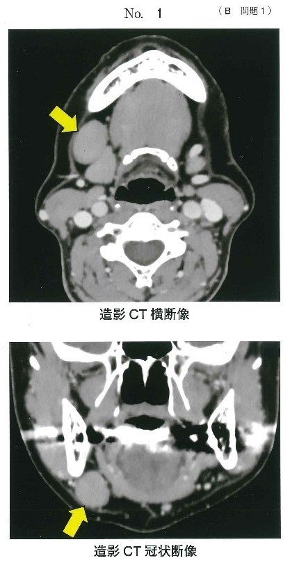 リンパ節腫脹の造影CT