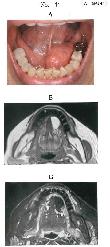 口腔内写真、MRI T1強調横断像及び脂肪抑制T2強調横断像