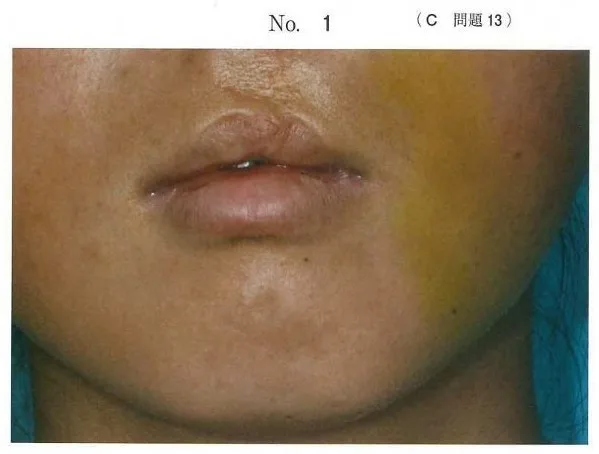 歯科医師国家試験 第115回 C13問題 | 歯科国試ドットコム