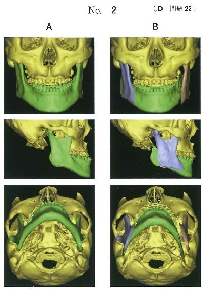 下顎前突症患者の術前3D-CTとCTを用いたシミュレーション像