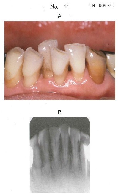 下顎前歯部の口腔内写真とエックス線画像