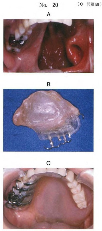 口腔内写真、ある装置の粘膜面観の写真、及び装置装着後の口腔内写真