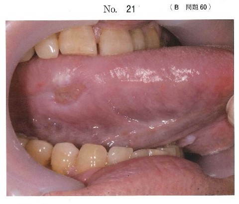 初診時の舌縁の写真