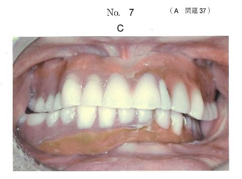 義歯装着時の口腔内写真