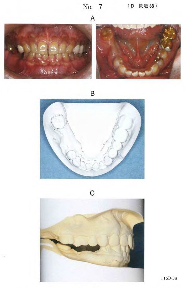 口腔内写真、下顎研究用模型検査時の写真及び上下顎模型の右側面観の写真