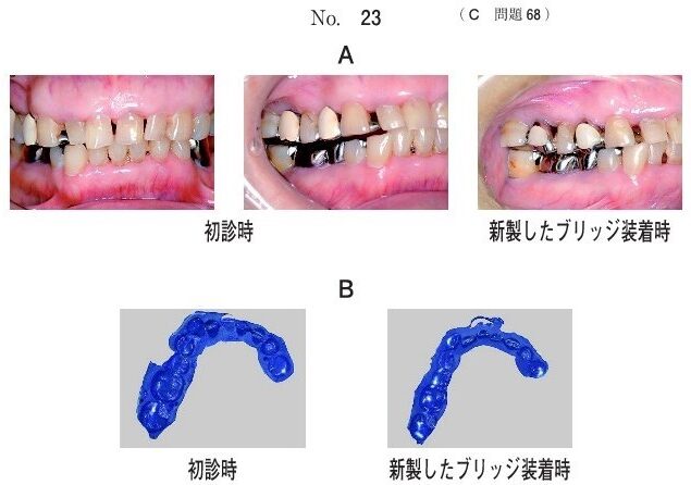 咬頭嵌合位の口腔内写真と、ある検査の写真