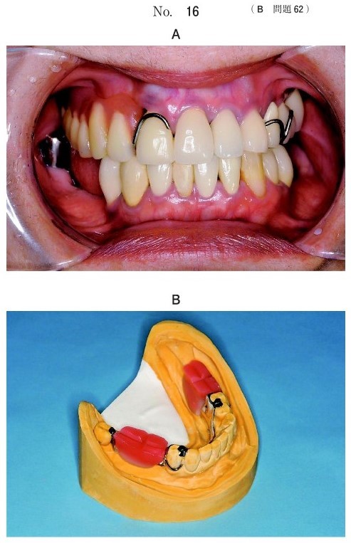 下顎義歯撤去時の口腔内写真と作業用模型上で製作した装置の写真