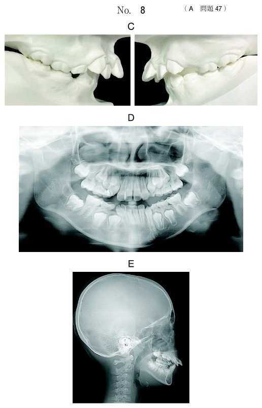 口腔模型の写真、エックス線画像及び側面頭部エックス線規格写真