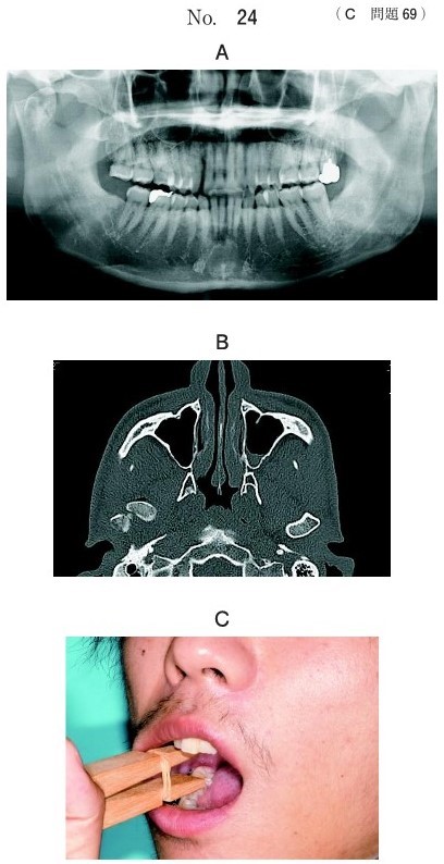 エックス線画像、CT及び顎間固定解除後のある訓練時の写真