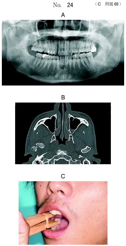 歯科医師国家試験 第113回 C69問題 | 歯科国試ドットコム