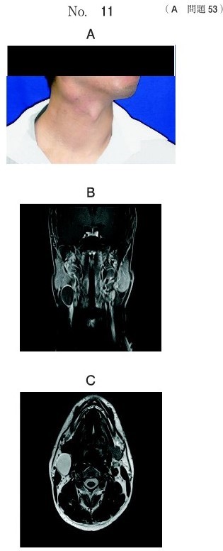 顔貌写真、MRI脂肪抑制造影Τ1強調冠状断像、T2強調横断像
