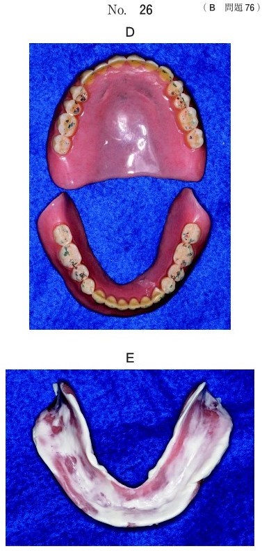 印記した義歯の写真及び適合検査後の義歯の写真