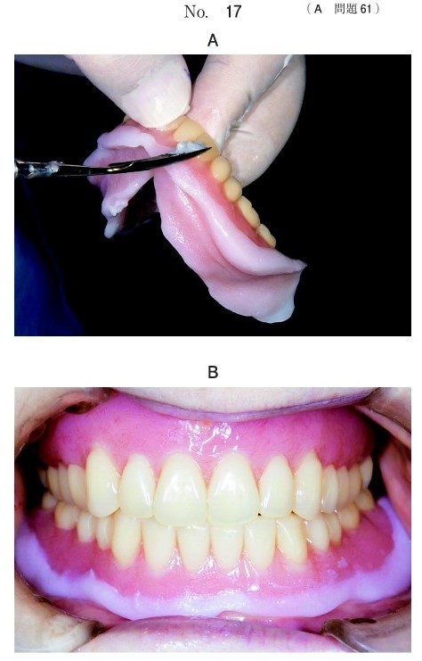 処置の操作中の写真と操作後の義歯装着時の口腔内写真