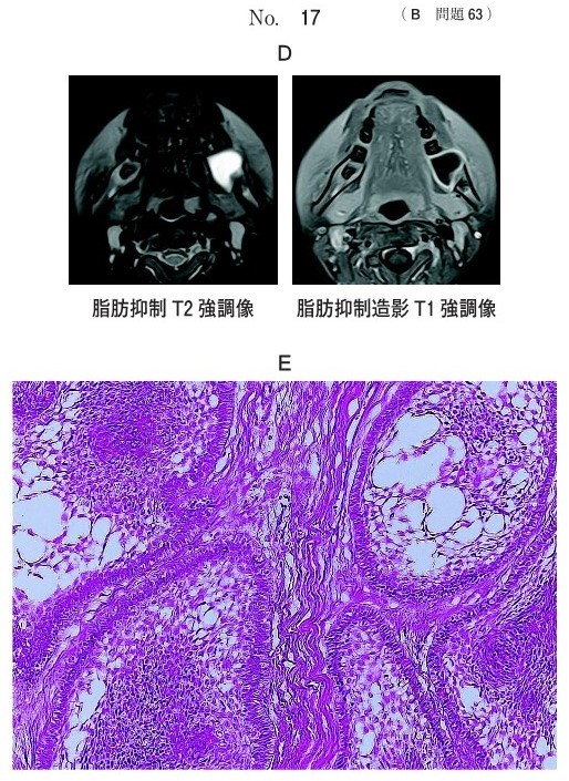 MRI及び生検時のΗ-E染色病理組織像