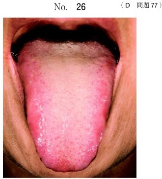 初診時の舌の写真