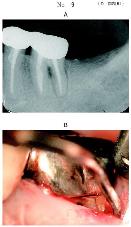 エックス線画像(別冊No.9A)と頰側歯頸部歯肉圧排時の口腔内写真