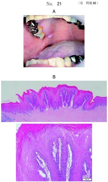 口蓋の病変の写真とΗ-E染色病理組織像