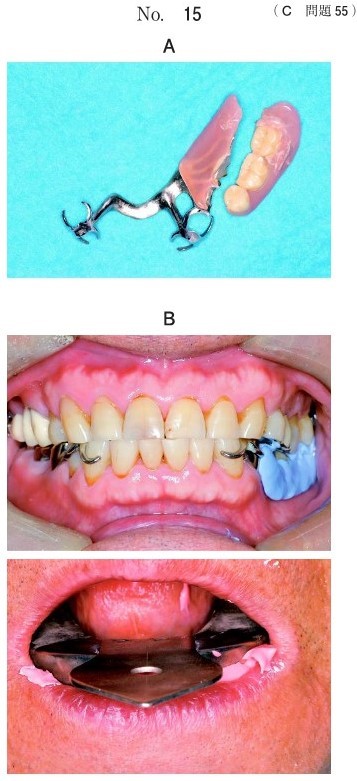 義歯の写真、印象採得時の口腔内写真