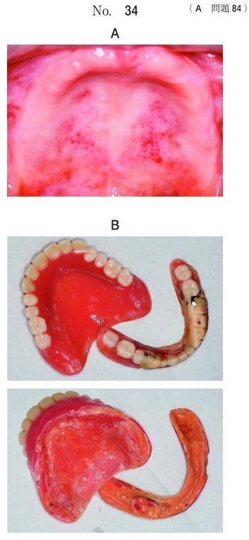 口腔内写真と使用中の義歯の写真