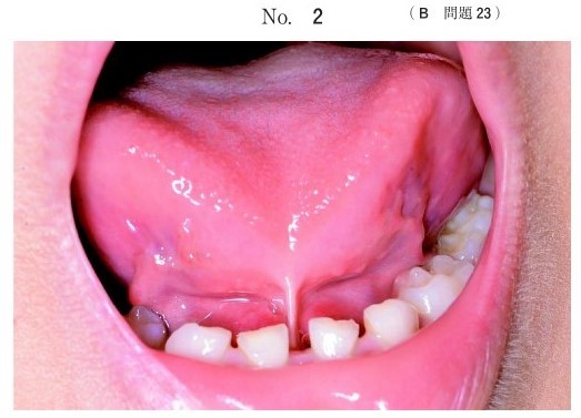 舌挙上時の口腔内写真