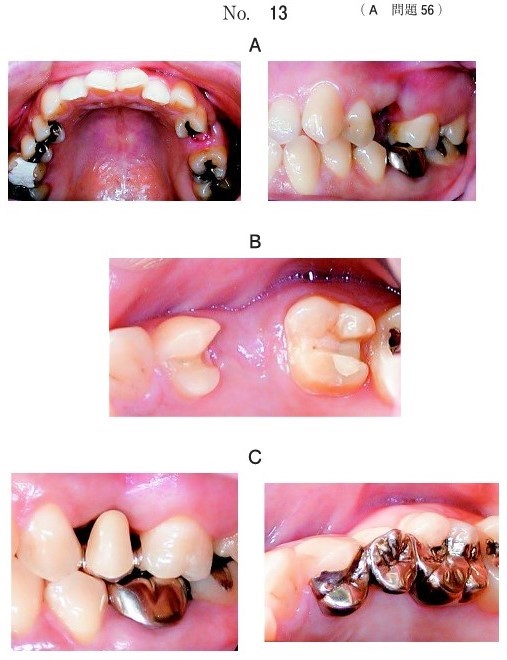 口腔内写真(別冊No.13A)、支台歯形成後の口腔内写真及びブリッジ装着時の口腔内写真