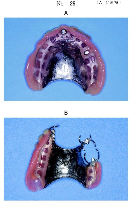 2種類の有床義歯の写真