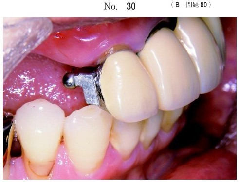 部分床義歯の支台装置の写真