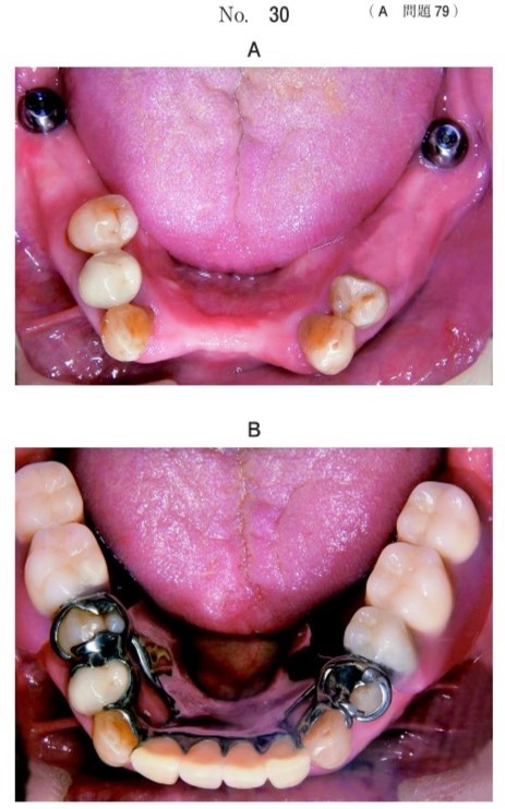 インプラント埋入後の写真と義歯装着時の写真