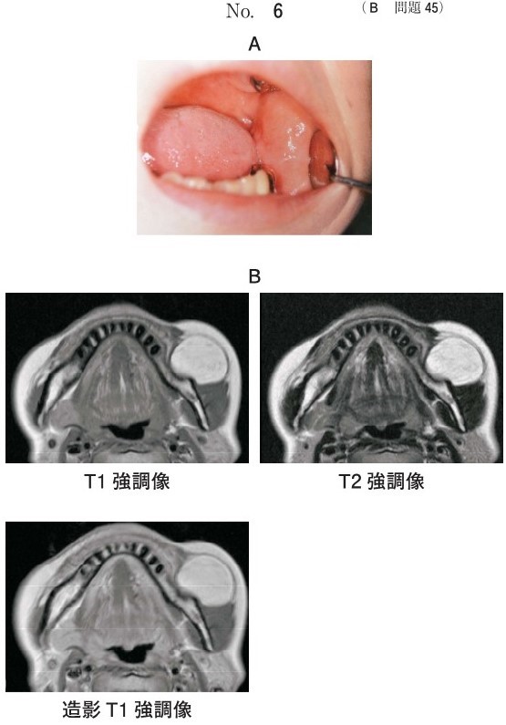 口腔内写真とMRI T1強調像、T2強調像および造影T1強調像