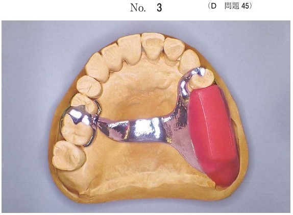 義歯製作中のある過程の写真