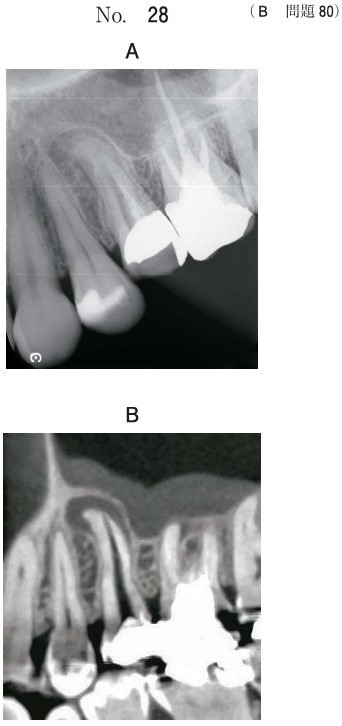 エックス線画像と歯科用コーンビームCT矢状断像