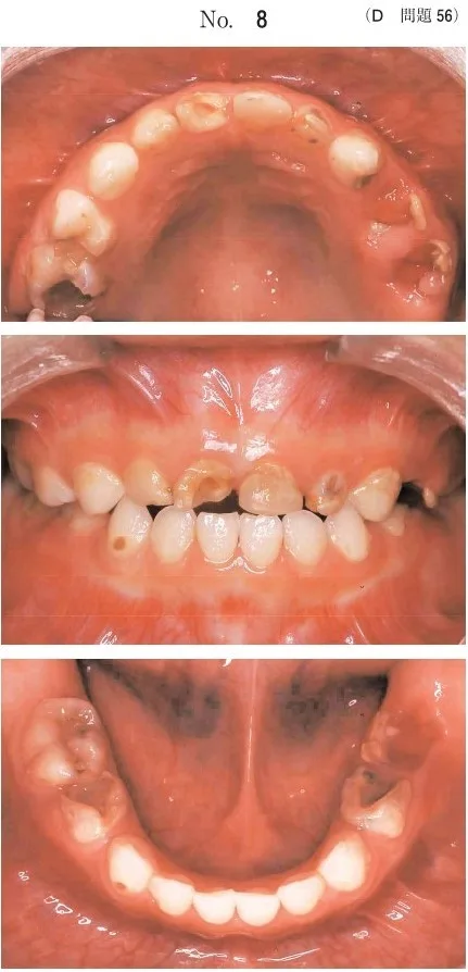 歯科医師国家試験 第112回 D56問題 | 歯科国試ドットコム
