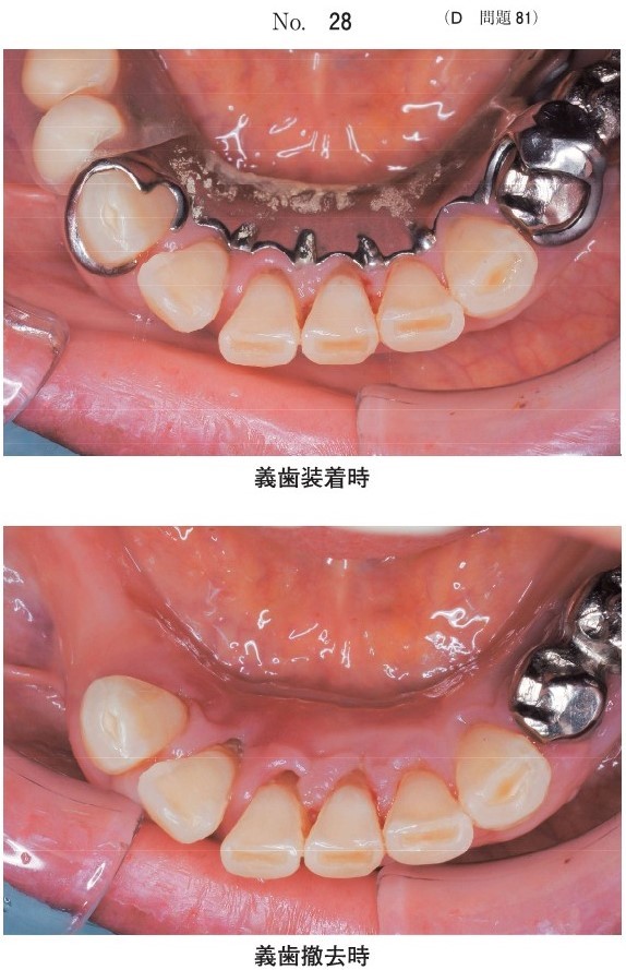 初診時の義歯装着時と義歯撤去時の口腔内写真