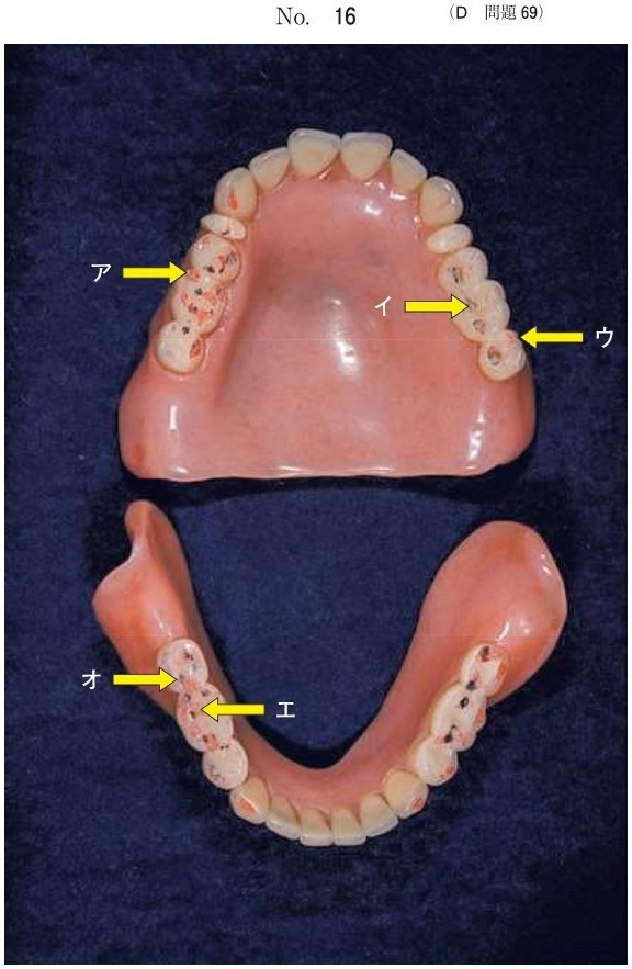 側方運動時(赤)とタッピング時(青)の咬合接触を印記した義歯の写真
