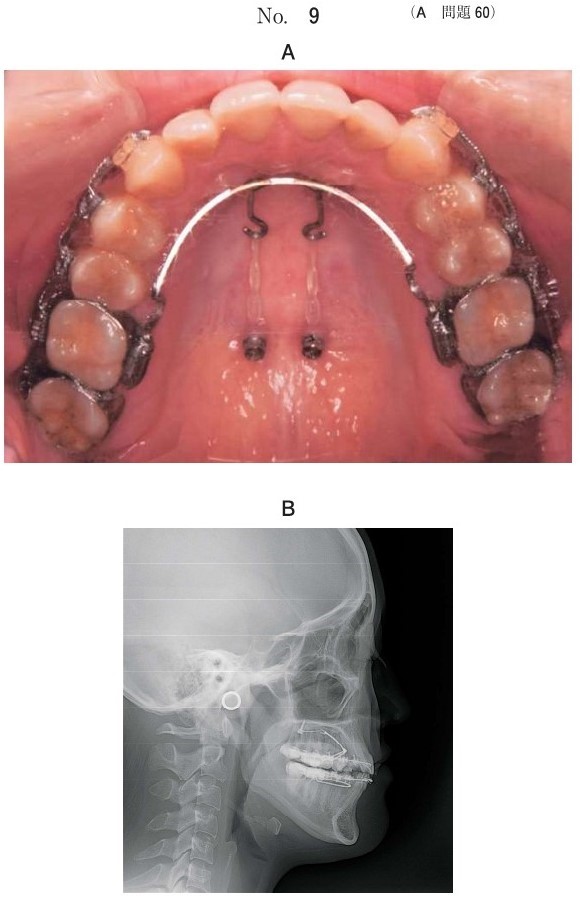 口腔内写真と側面頭部エックス線規格写真