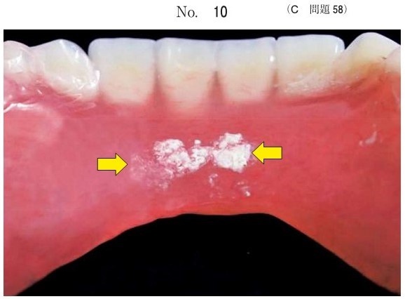 下顎全部床義歯の写真