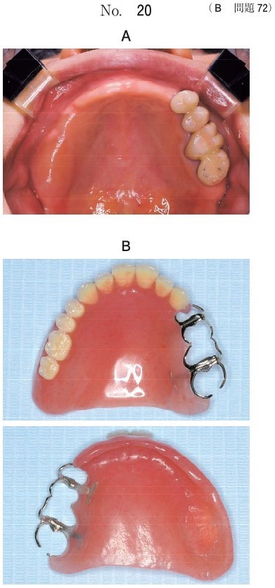 口腔内写真、製作した義歯の写真