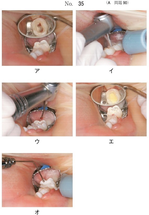 治療過程の一連の口腔内写真